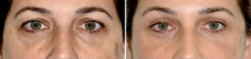 Blepharoplasty (eyelids) Before and After Photos in Miami, FL, Patient 29996