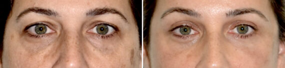 Blepharoplasty (eyelids) Before and After Photos in Miami, FL, Patient 29996