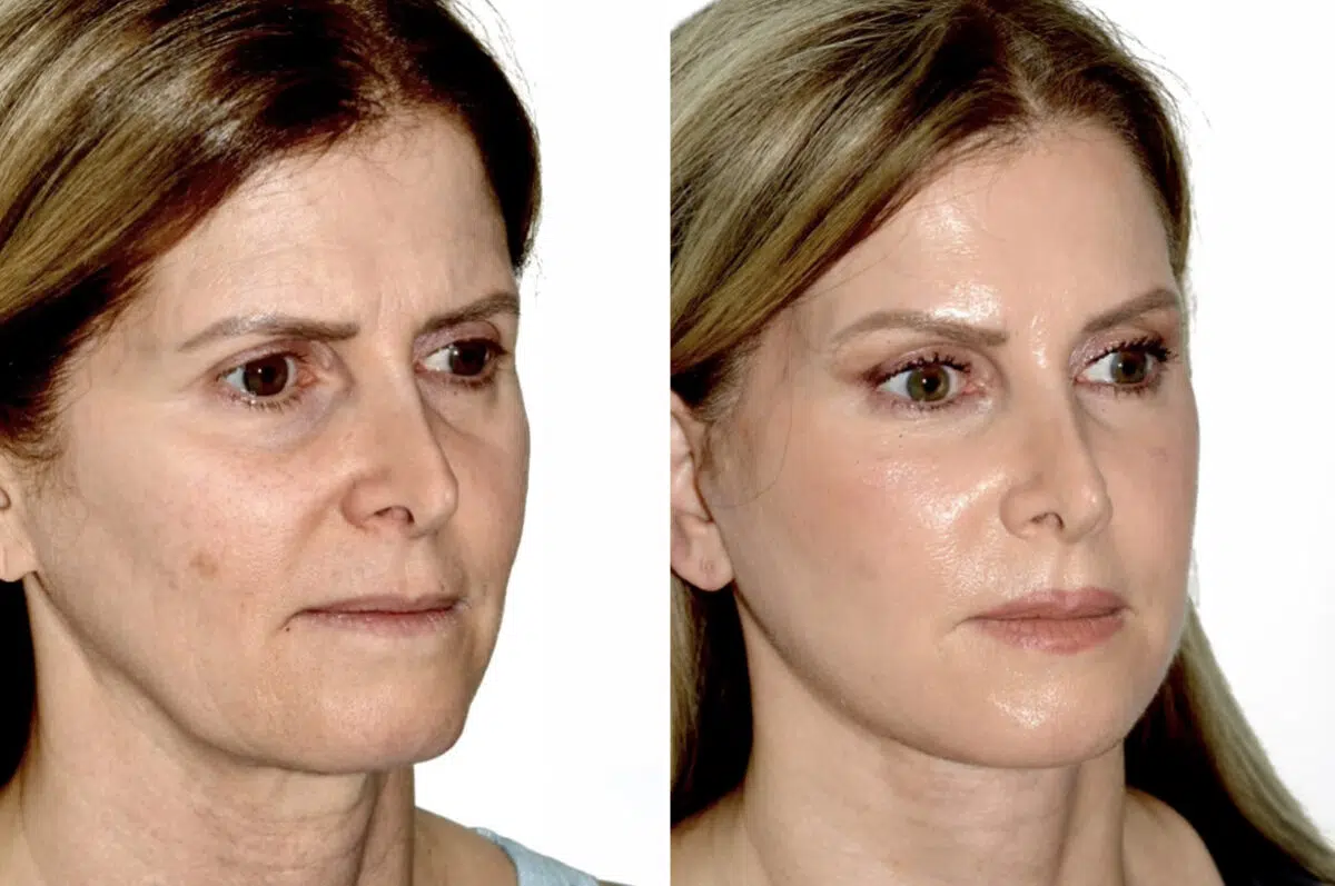 Brow Lift Before and After Photos in Miami, FL, Patient 30006