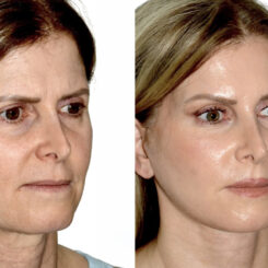 Brow Lift Before and After Photos in Miami, FL, Patient 30006