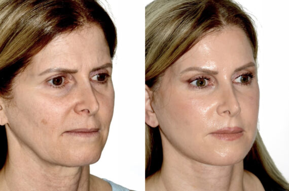 Brow Lift Before and After Photos in Miami, FL, Patient 30006