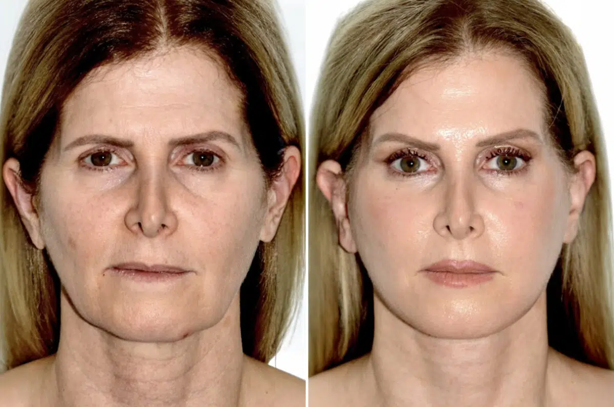 Brow Lift Before and After Photos in Miami, FL, Patient 30006