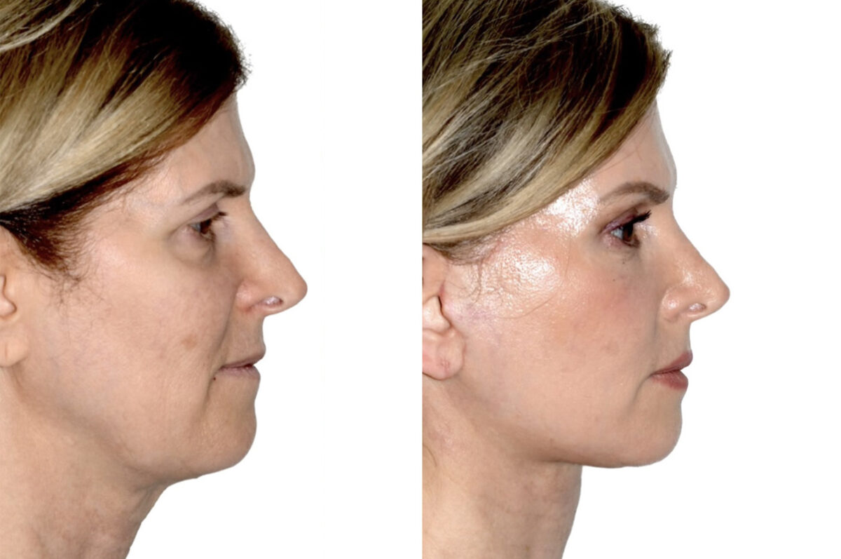 Brow Lift Before and After Photos in Miami, FL, Patient 30006