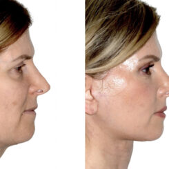 Brow Lift Before and After Photos in Miami, FL, Patient 30006