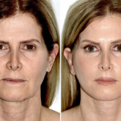 Brow Lift Before and After Photos in Miami, FL, Patient 30006