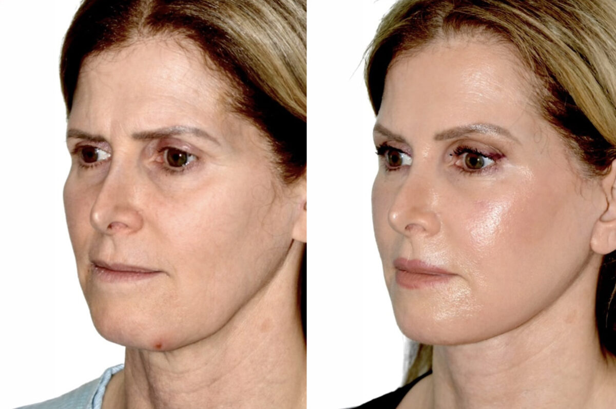 Brow Lift Before and After Photos in Miami, FL, Patient 30006