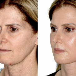 Brow Lift Before and After Photos in Miami, FL, Patient 30006