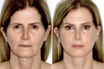 Deep Plane Facelift Before and After Photos in Miami, FL, Patient 30006