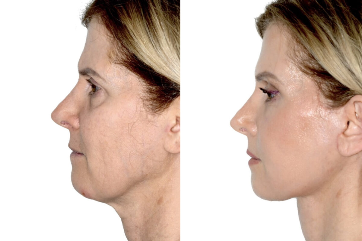 Brow Lift Before and After Photos in Miami, FL, Patient 30006