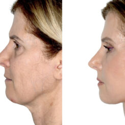 Brow Lift Before and After Photos in Miami, FL, Patient 30006