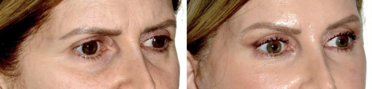Blepharoplasty (eyelids) Before and After Photos in Miami, FL, Patient 30023