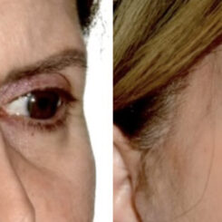 Blepharoplasty (eyelids) Before and After Photos in Miami, FL, Patient 30023