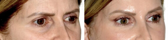 Blepharoplasty (eyelids) Before and After Photos in Miami, FL, Patient 30023