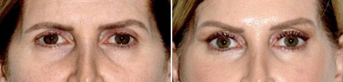 Blepharoplasty (eyelids) Before and After Photos in Miami, FL, Patient 30023