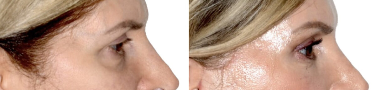 Blepharoplasty (eyelids) Before and After Photos in Miami, FL, Patient 30023