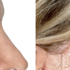 Blepharoplasty (eyelids) Before and After Photos in Miami, FL, Patient 30023