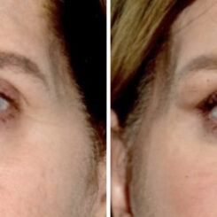 Blepharoplasty (eyelids) Before and After Photos in Miami, FL, Patient 30023