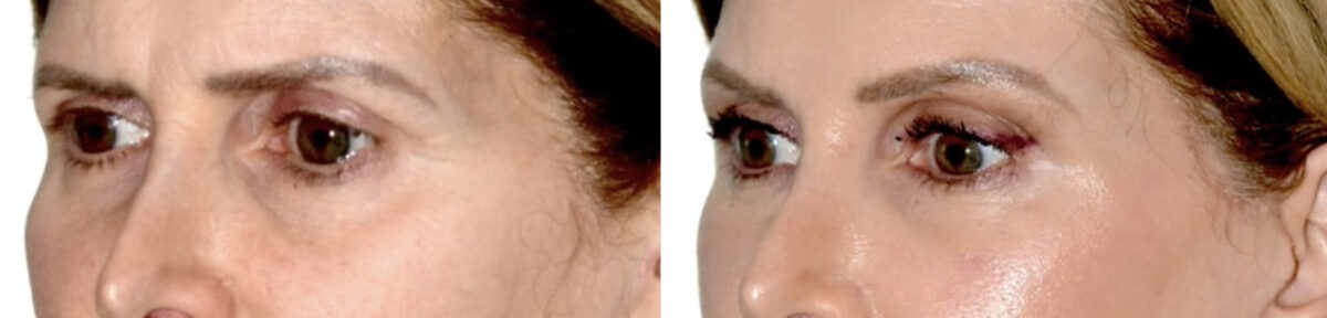 Blepharoplasty (eyelids) Before and After Photos in Miami, FL, Patient 30023