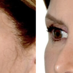 Blepharoplasty (eyelids) Before and After Photos in Miami, FL, Patient 30023
