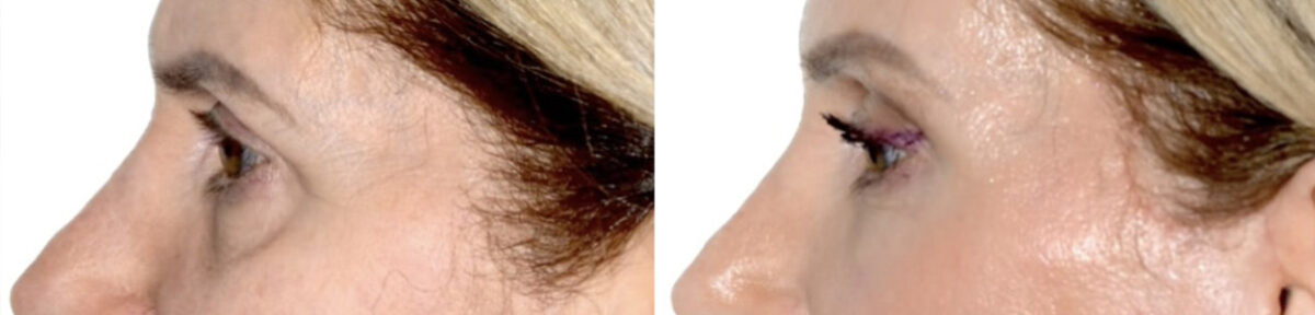 Blepharoplasty (eyelids) Before and After Photos in Miami, FL, Patient 30023