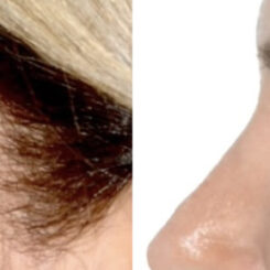 Blepharoplasty (eyelids) Before and After Photos in Miami, FL, Patient 30023