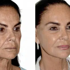 Deep Plane Facelift Before and After Photos in Miami, FL, Patient 30039