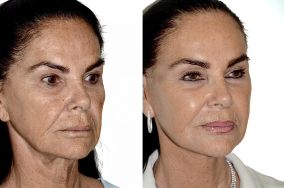 Deep Plane Facelift Before and After Photos in Miami, FL, Patient 30039