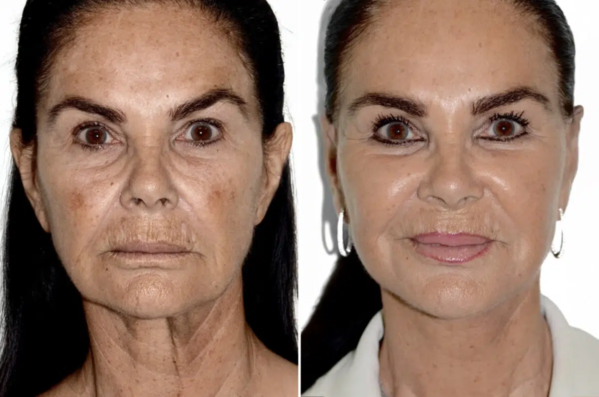 Deep Plane Facelift Before and After Photos in Miami, FL, Patient 30039