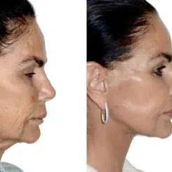 Deep Plane Facelift Before and After Photos in Miami, FL, Patient 30039
