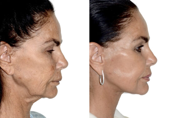 Deep Plane Facelift Before and After Photos in Miami, FL, Patient 30039