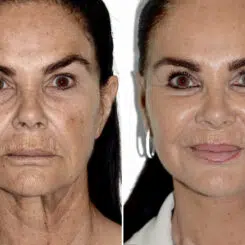 Deep Plane Facelift Before and After Photos in Miami, FL, Patient 30039