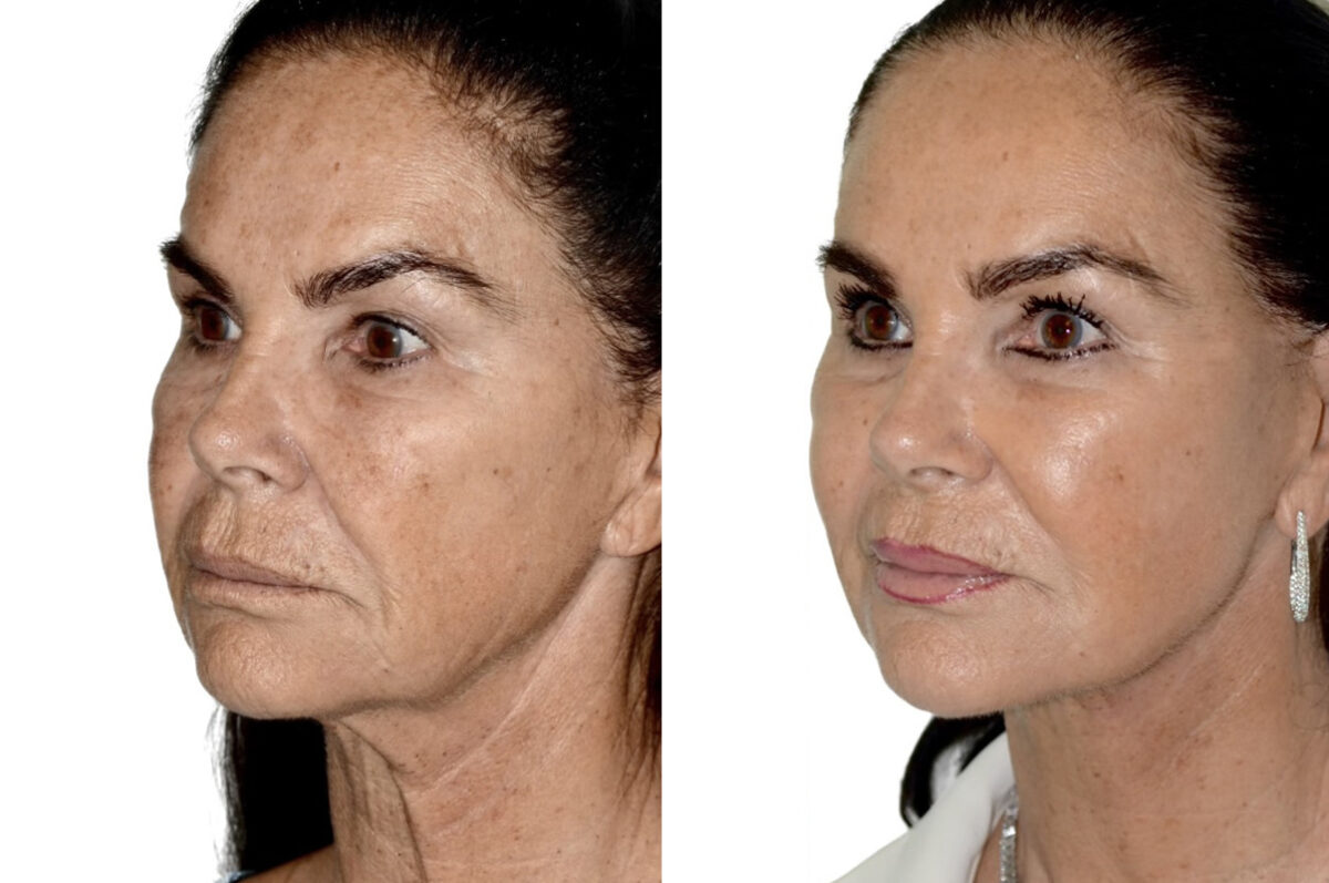Deep Plane Facelift Before and After Photos in Miami, FL, Patient 30039