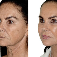 Deep Plane Facelift Before and After Photos in Miami, FL, Patient 30039