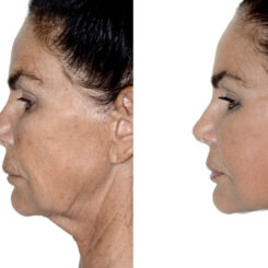 Deep Plane Facelift Before and After Photos in Miami, FL, Patient 30039