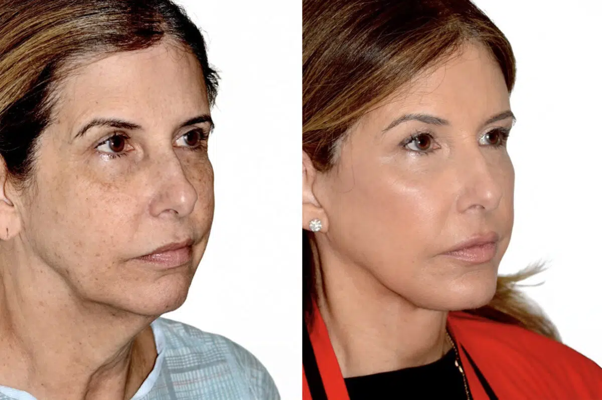 Brow Lift Before and After Photos in Miami, FL, Patient 30056