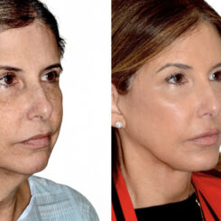 Brow Lift Before and After Photos in Miami, FL, Patient 30056