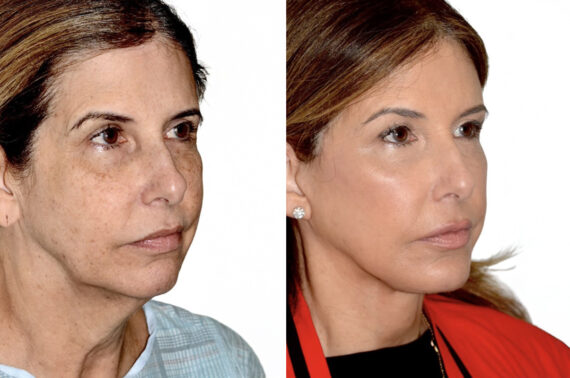 Brow Lift Before and After Photos in Miami, FL, Patient 30056