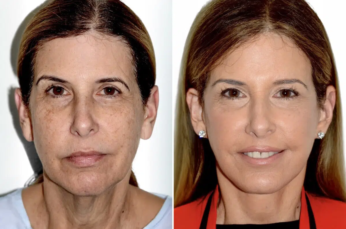 Brow Lift Before and After Photos in Miami, FL, Patient 30056