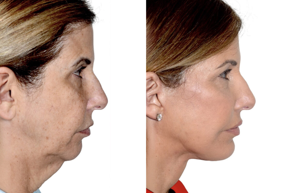 Brow Lift Before and After Photos in Miami, FL, Patient 30056