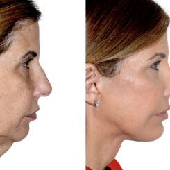 Brow Lift Before and After Photos in Miami, FL, Patient 30056