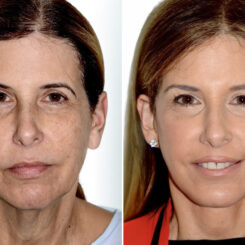 Brow Lift Before and After Photos in Miami, FL, Patient 30056