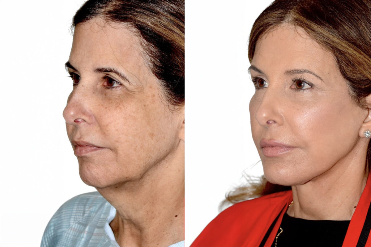 Brow Lift Before and After Photos in Miami, FL, Patient 30056