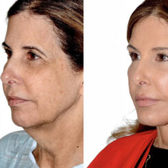 Brow Lift Before and After Photos in Miami, FL, Patient 30056