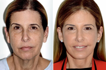 Brow Lift Before and After Photos in Miami, FL, Patient 30056