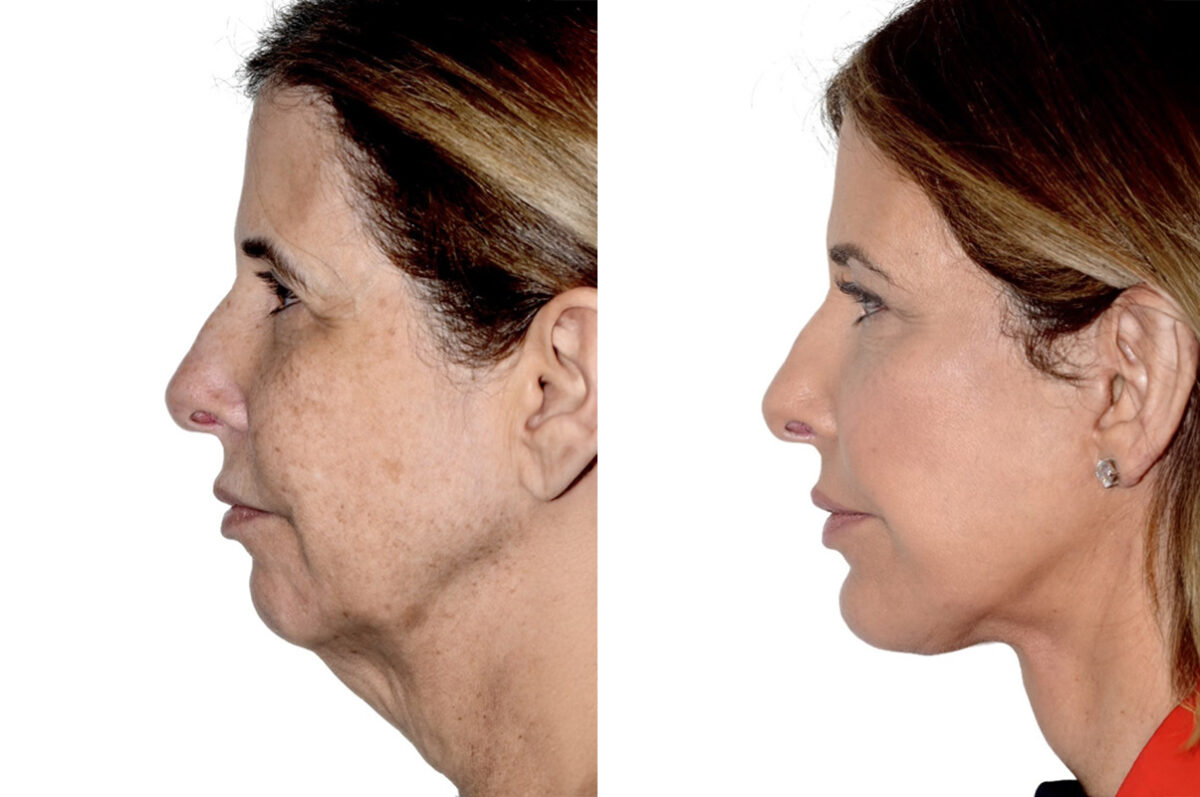 Brow Lift Before and After Photos in Miami, FL, Patient 30056