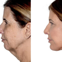 Brow Lift Before and After Photos in Miami, FL, Patient 30056