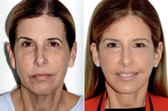 Facial Fat Transfer Before and After Photos in Miami, FL