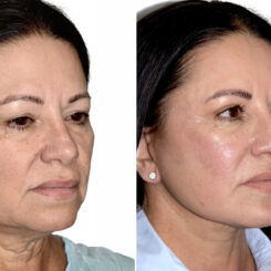 Deep Plane Facelift Before and After Photos in Miami, FL, Patient 30072