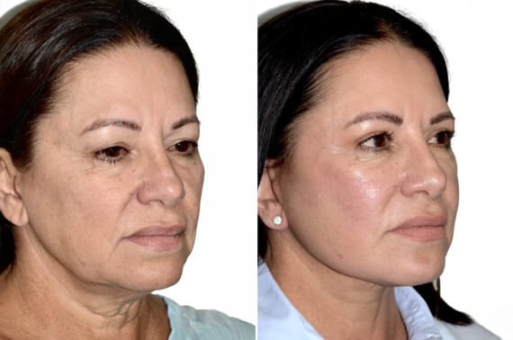 Deep Plane Facelift Before and After Photos in Miami, FL, Patient 30072