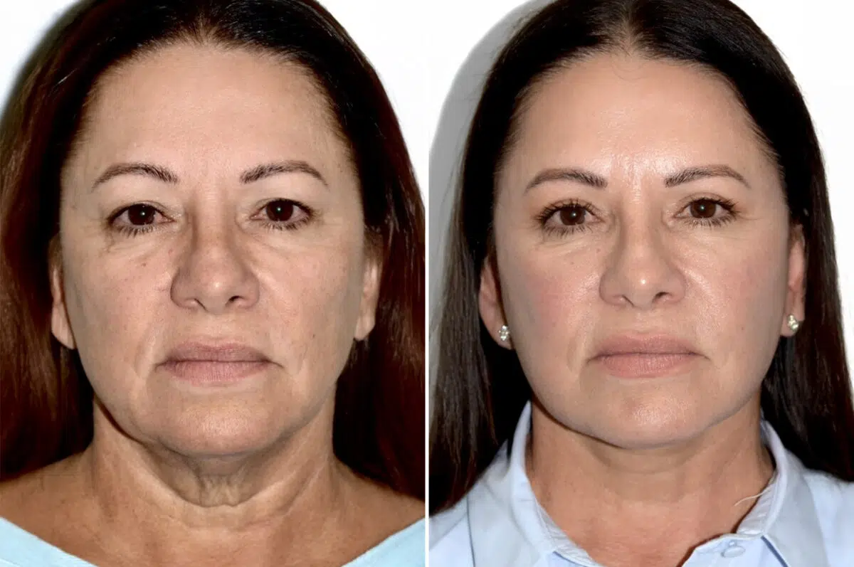 Deep Plane Facelift Before and After Photos in Miami, FL, Patient 30072